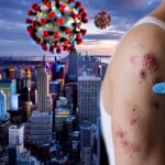Mpox-Alarm in New York: neue aggressive Virusvariante entdeckt